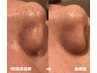 【いちご鼻撃退】お顔脱毛&毛穴洗浄1回6600円