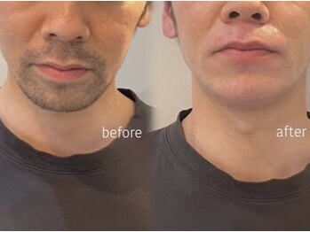 ハリウッドブロウリフト ワクシー 表参道店(HOLLYWOOD BROW LIFT WAXYYY.)/ 髭W脱毛