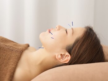 エヌ(N)/【美容鍼】小顔/むくみ/眼精疲労