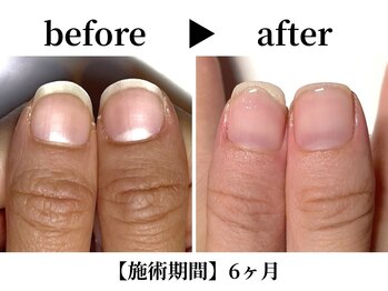 リング ザ ベル(ring the bell)/深爪スタンダードコース¥11,000