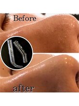 ウィッシュ 与野(Wish)/吸引結果 /　皮膚呼吸が再開 