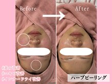 エンクリニカルラボ 京都駅前店(E&N CLINICAL LABO)/低刺激！ハーブピーリング