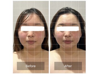 小顔コルギ専門店irohanaの写真/韓国発！美顔造形コルギで骨格から筋肉へアプローチ。むくみ・くすみを一掃し、スッキリ引き締まった小顔へ