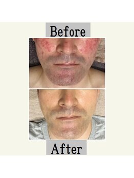 ペールノエル 静岡店(PERE NOEL)/フォトエステ(40代男性）