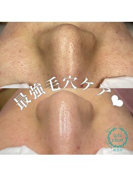 アデュラリアン(Adularian)/毛穴エクストラクション