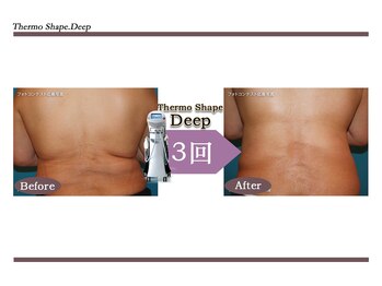 Nビューティー/最新エンダモロジーBODY