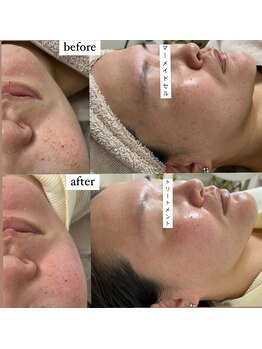 ミ ジュエル(me jewel)/むくみスッキリ即小顔ケア