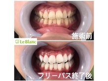 ルブラン 奈良店(Le Blanc)/回数を重ねた分白く！！