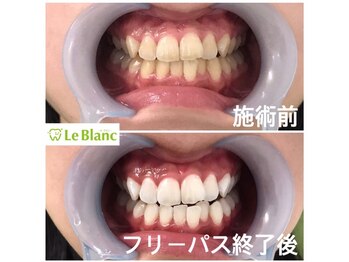 ルブラン 奈良店(Le Blanc)/回数を重ねた分白く!!