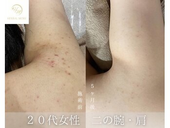 ウルワシ(Uruwashi)/ハーバルモアハーブピーリング