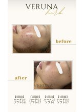 ココ 2号店(CoCo)/ハーブピーリング/改善例