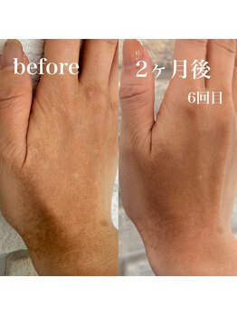 スイ(Sui)/美肌光フェイシャル　光脱毛