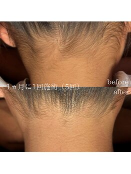 アール(ar.)/えりあし・うなじ脱毛（5回）