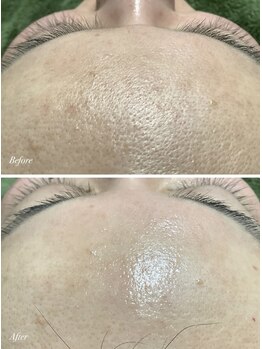 エミルカ 仙台(EMILUCA)/白玉wax（全顔脱毛）付き