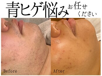 スポット 薬院駅前店(SPOT)/剃り負け青ヒゲ悩みならヒゲ脱毛