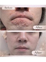 プリベンティブ ビューティー ティップス(Preventive Beauty Tips)/ニキビ改善ビフォーアフター