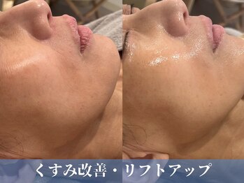 シュリー(Sriii)の写真/水光肌へ♪シミくすみ改善/ハリツヤ肌になる/エンビロン/セルマン美肌育成トリートメント