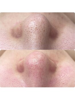 プアラ(puala)/ビフォーアフター