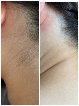 ノノ(nono)/うなじ脱毛