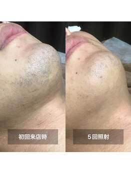 リムル(REMURU)/ひげ脱毛5回照射