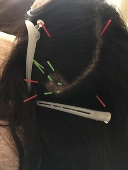 ハリス(HARIS)/経過　毛根活性＆頭皮環境