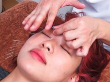 松尾美容鍼灸×整体 香椎/美容鍼施術風景です。