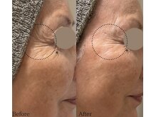 ベルダ(BELDAD)/エクソソーム