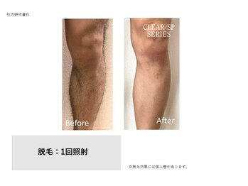 フェレザ 新潟(Felleza)/セルフ脱毛で気軽にムダ毛処理