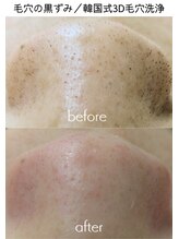 ビューティフィーサロン ベルル(Belulu)/3D毛穴洗浄／ビフォーアフター