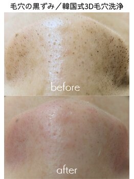 ビューティフィーサロン ベルル(Belulu)/3D毛穴洗浄／ビフォーアフター