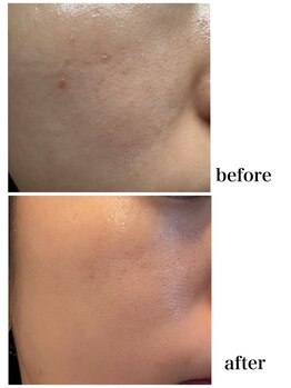 マロン(MARON)/30代女性/白ニキビ