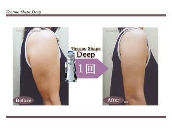 Nビューティー/最新RFサーモシェイプオーパス
