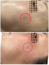 ミンア(Min-a)/シミケア　モニター様結果