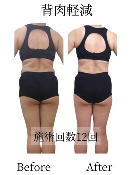 はなす/筋膜リリース12回めBefore After