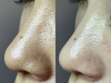 エミュ(emu)/お肌ざらつく方は毛穴ケア♪