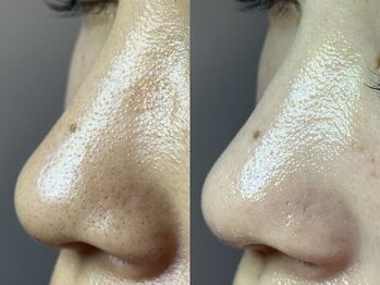 エミュ(emu)/お肌ざらつく方は毛穴ケア♪