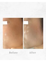 ミラ(Mila)/光フェイシャル+ポレーション