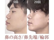 ラプリ 新宿店(Raplit)/隆鼻＋輪郭矯正40分20回