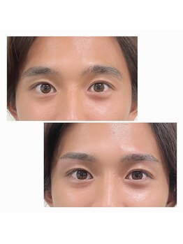 リンク(LINK)/眉毛症例