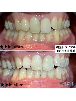 ビーバイビー(BBYB)/セルフホワイトニング初回体験