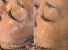 ミモア(mimoi.)/結果重視★フェイシャルケア