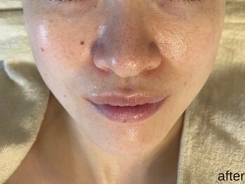 サロン ド エメ(salon de aimer)/【After】本格毛穴改善!