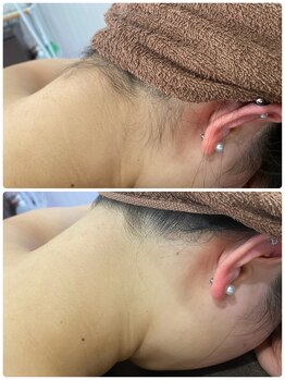 ボニート 堺東店(BONITO)/うなじ脱毛