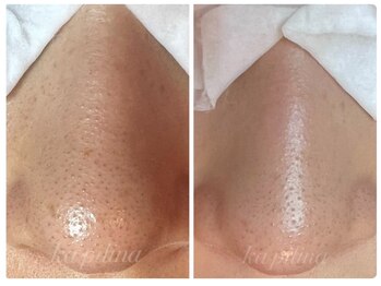 カピリナ(ka pilina)/毛穴もお肌も変わります！