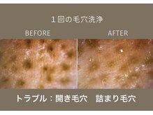 ステラ(Stella)/毛穴トラブル