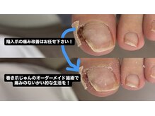 巻き爪じゅん 船橋店/陥入爪の痛み、1回で変化を実感