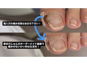 巻き爪じゅん 船橋店/陥入爪の痛み、1回で変化を実感
