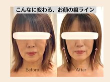 オリナサツキ(OlinaSatsuki)の雰囲気(年々長くなりがちなお顔も、しっかりリフトアップ)
