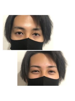 リンク(LINK)/眉毛症例