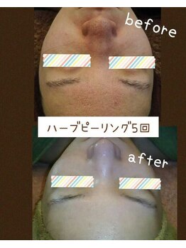 ラキュア(La Cure)/ハーブピーリングビフォーアフタ